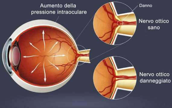 <p>glaucoma</p>